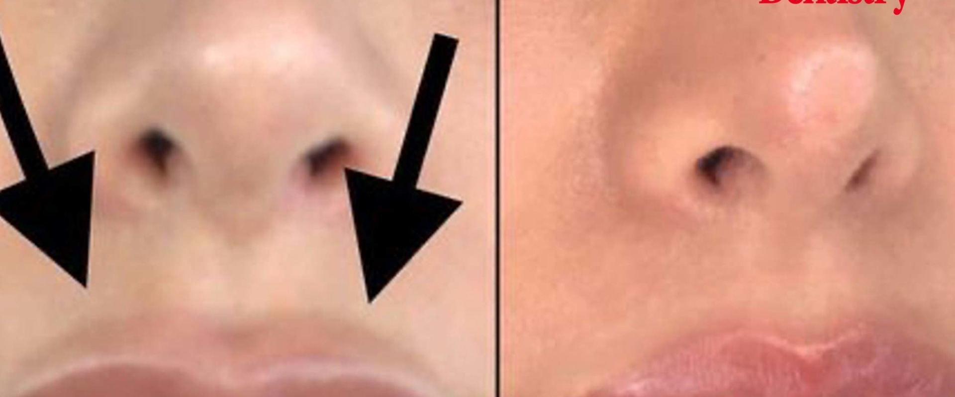 Dissolving Lip Fillers: What You Need to Know