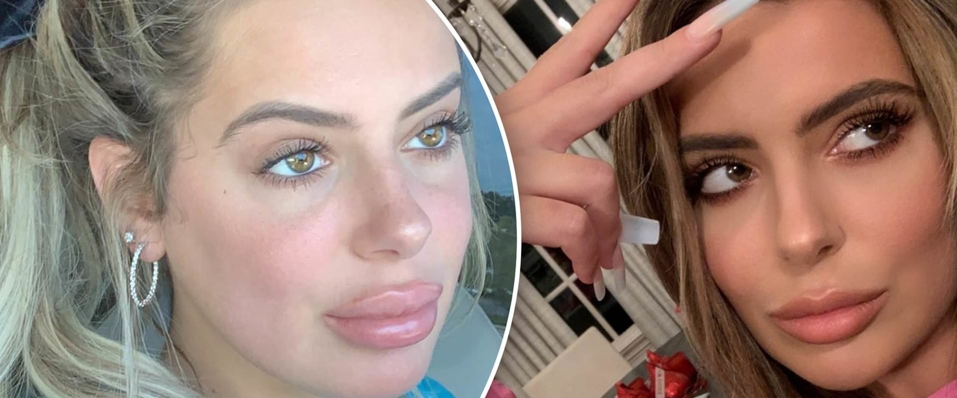 Do Lip Fillers Look Uneven at First?