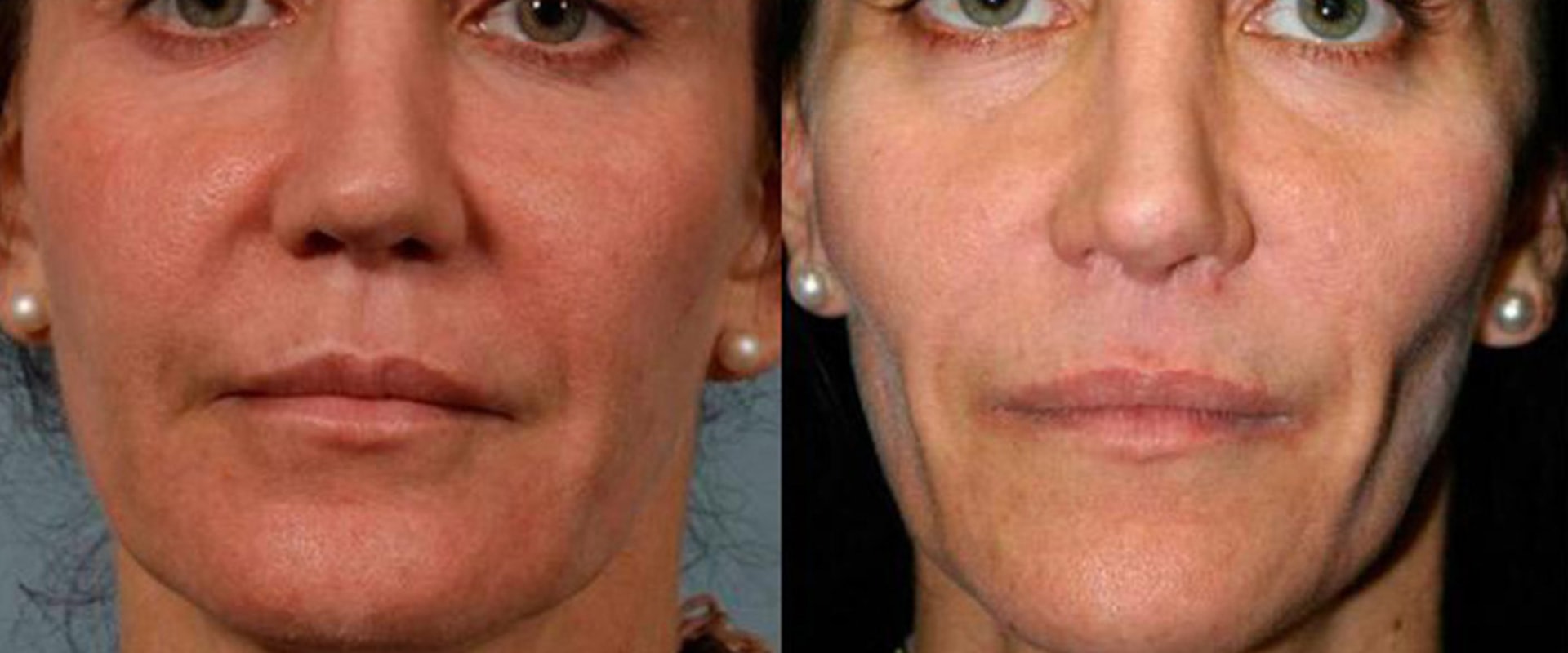 How Long Does it Take for Fillers to Look Normal?