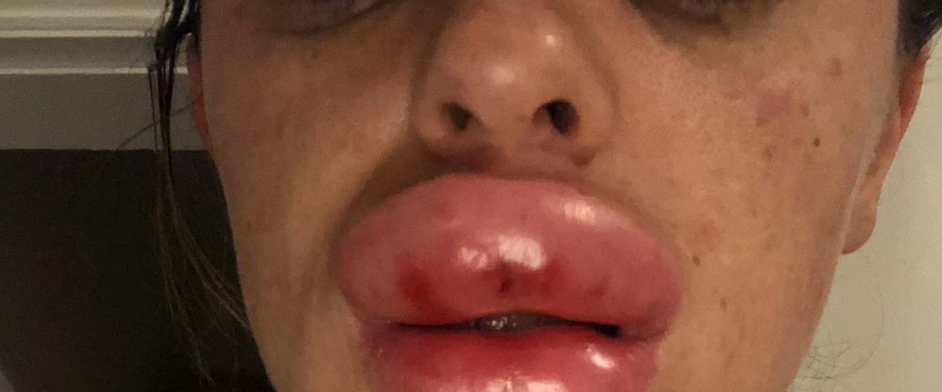 how-much-pain-is-normal-after-lip-fillers