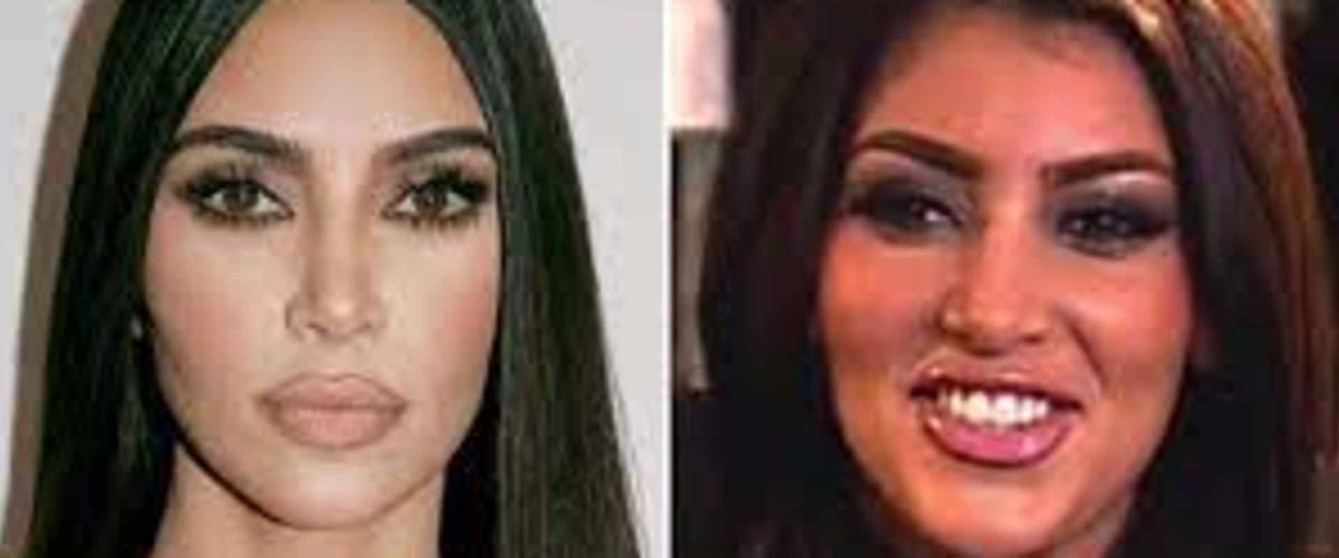 What Lip Fillers Do Kardashians Use?