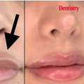 Dissolving Lip Fillers: What You Need to Know