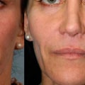 Weighing the Pros and Cons of Dermal Fillers