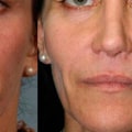 How Long Does it Take for Fillers to Look Normal?