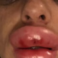 How Much Pain is Normal After Lip Fillers?