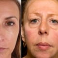 What Happens to Facial Fillers Over Time?