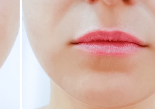 How Much Should Lip Fillers Cost?