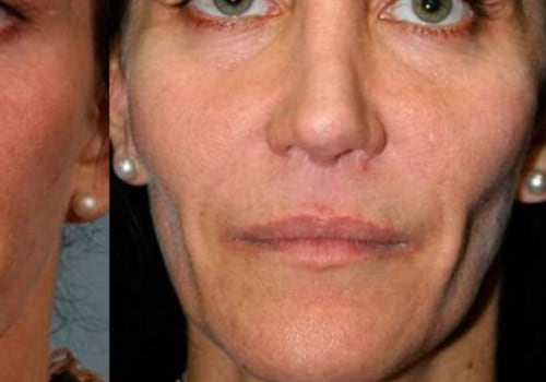 How Long Does it Take for Fillers to Look Normal?