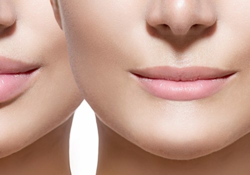 When Should I Worry About Lip Fillers?