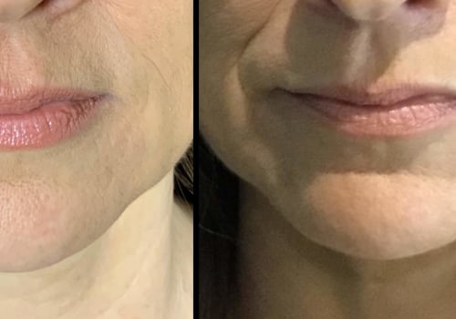 Do Fillers Affect Your Health?