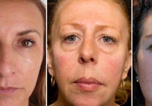 What Happens to Facial Fillers Over Time?